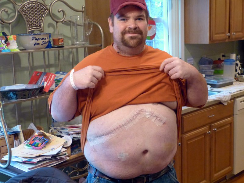 The Incision